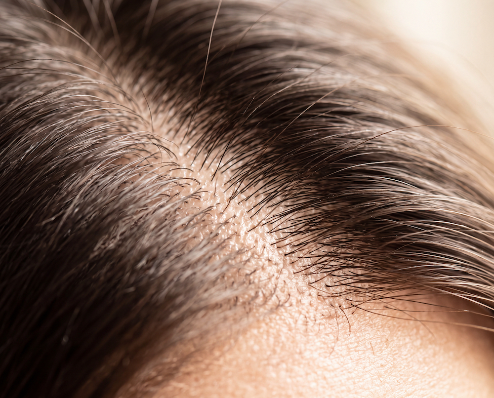 Close-up of thinning hair at the scalp